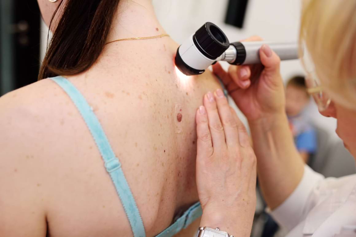 Melanomul malign avansat - prezent și perspective