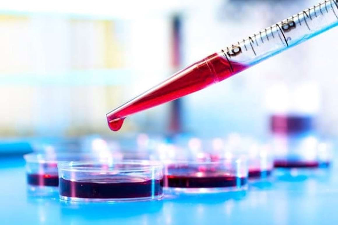 Primii biomarkeri pentru estimarea severitatii artrozei