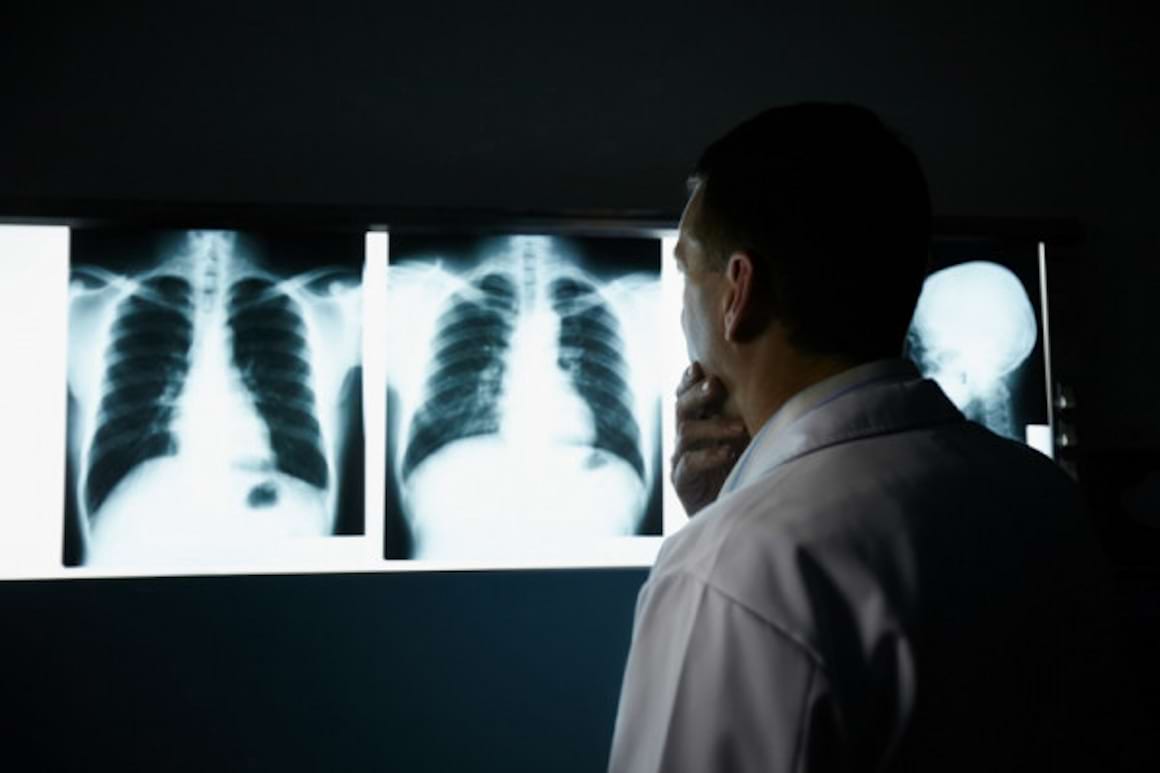 Cancerul bronhopulmonar fara celule mici