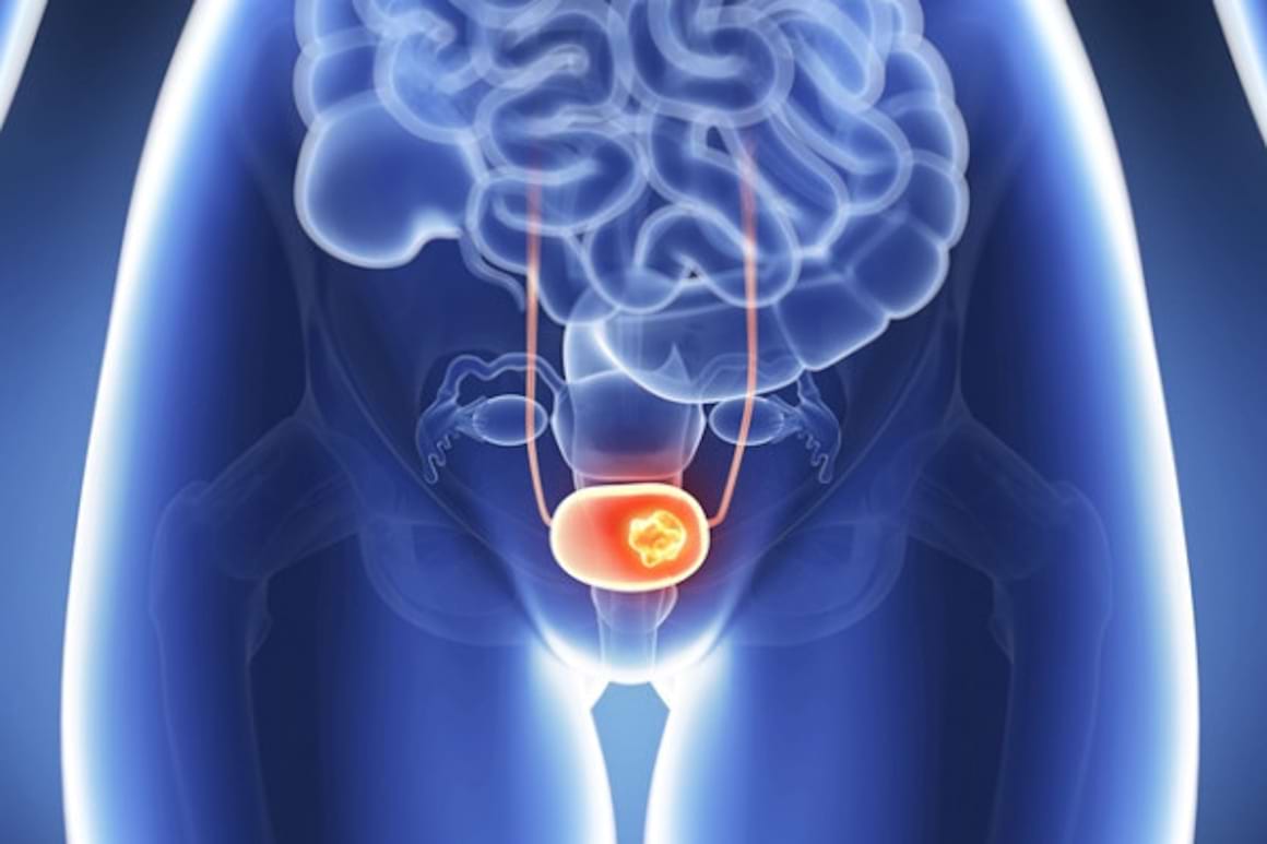 Concepte de baza in imunoterapia cancerului vezicii urinare