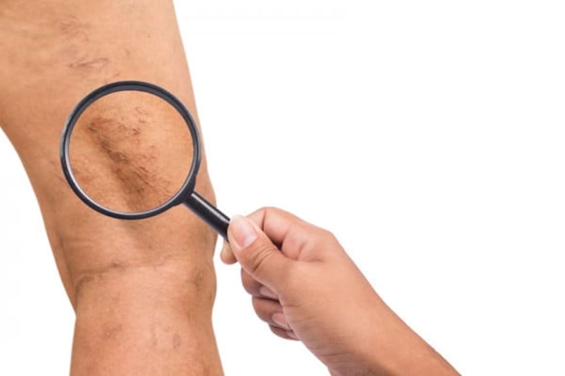 Ciorapii medicinali de compresie: cum ajuta in cazul insuficientei venoase