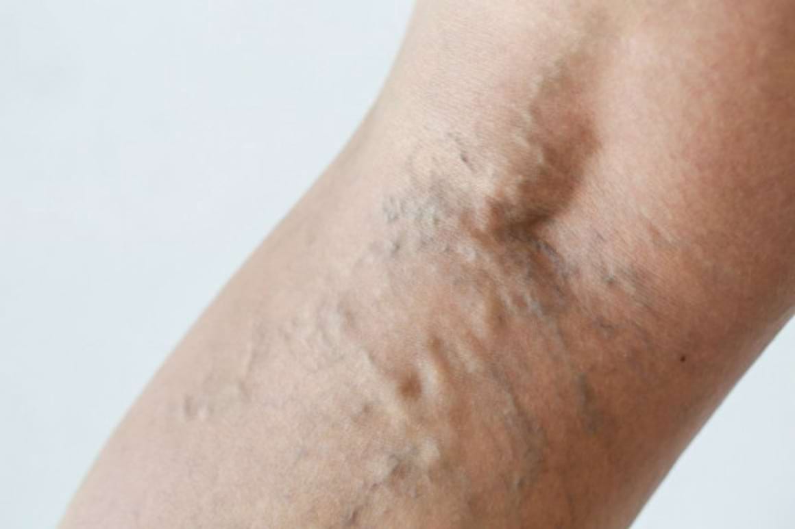 Clasificarea clinica a insuficientei venoase cronice