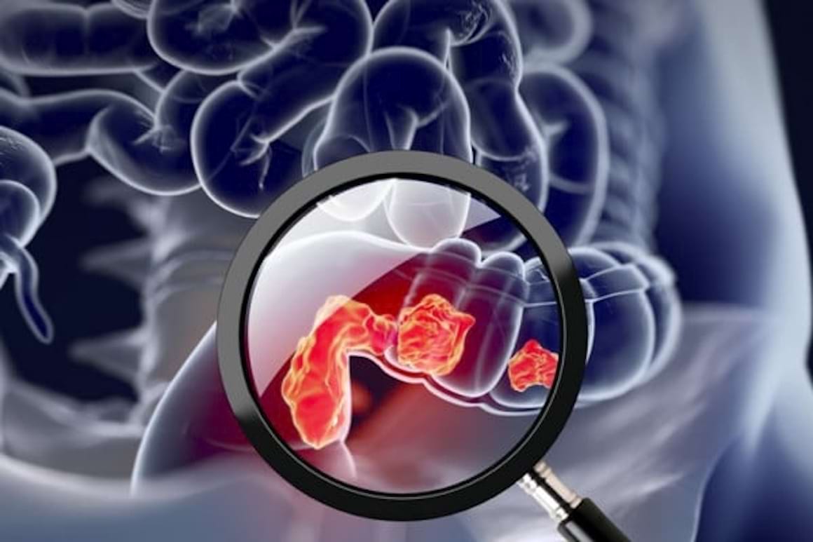 Cercetatorii au descoperit mecanismul prin care colita cauzeaza cancer colorectal
