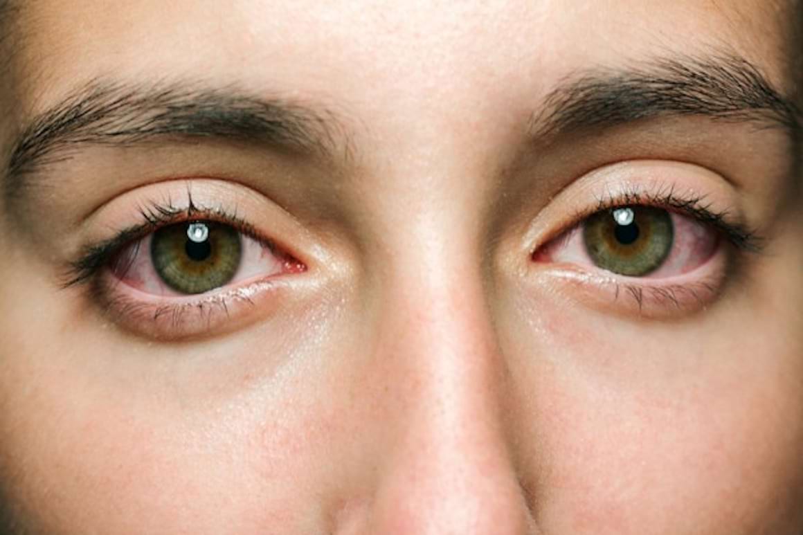 Sclerita la pacientul cu colita ulcerativa - ce impact are boala intestinala la nivel ocular