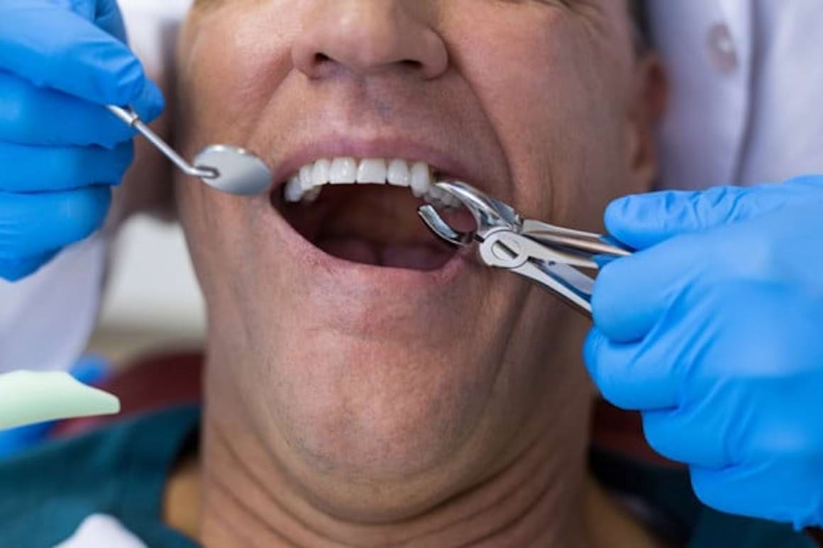 Extracția dentară: când se face și ce riscuri implică