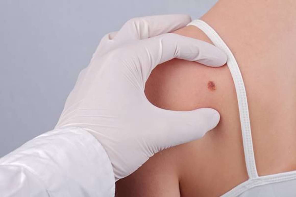Melanomul cutanat, o tumora frecventa