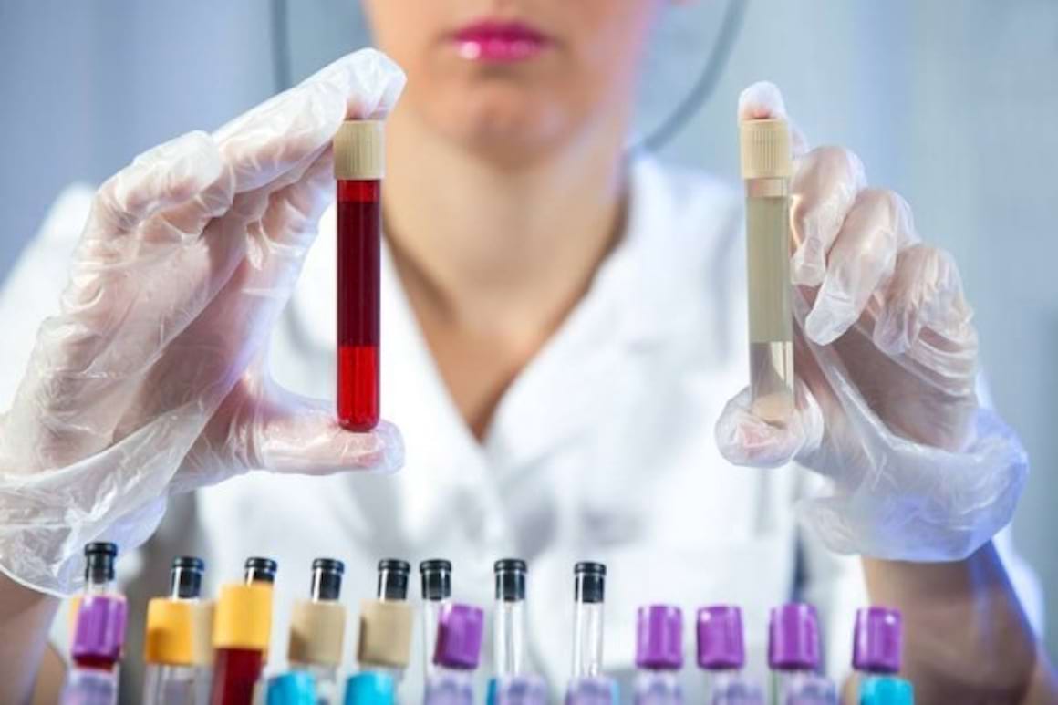 Corelatia intre severitatea gonartrozei si concentratia de sclerostin in plasma si in lichidul sinovial