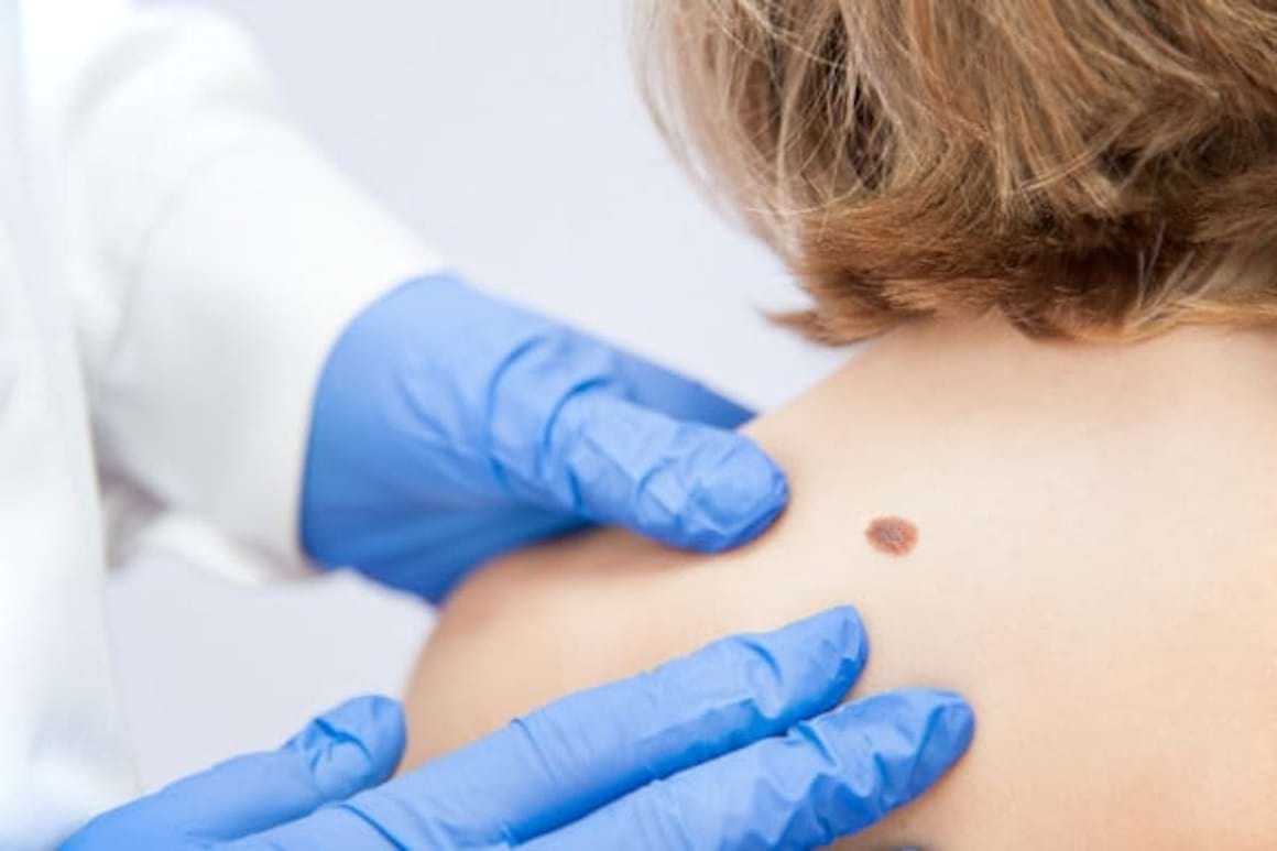 Imunoterapia in melanomul malign - monoterapie sau terapie combinata?
