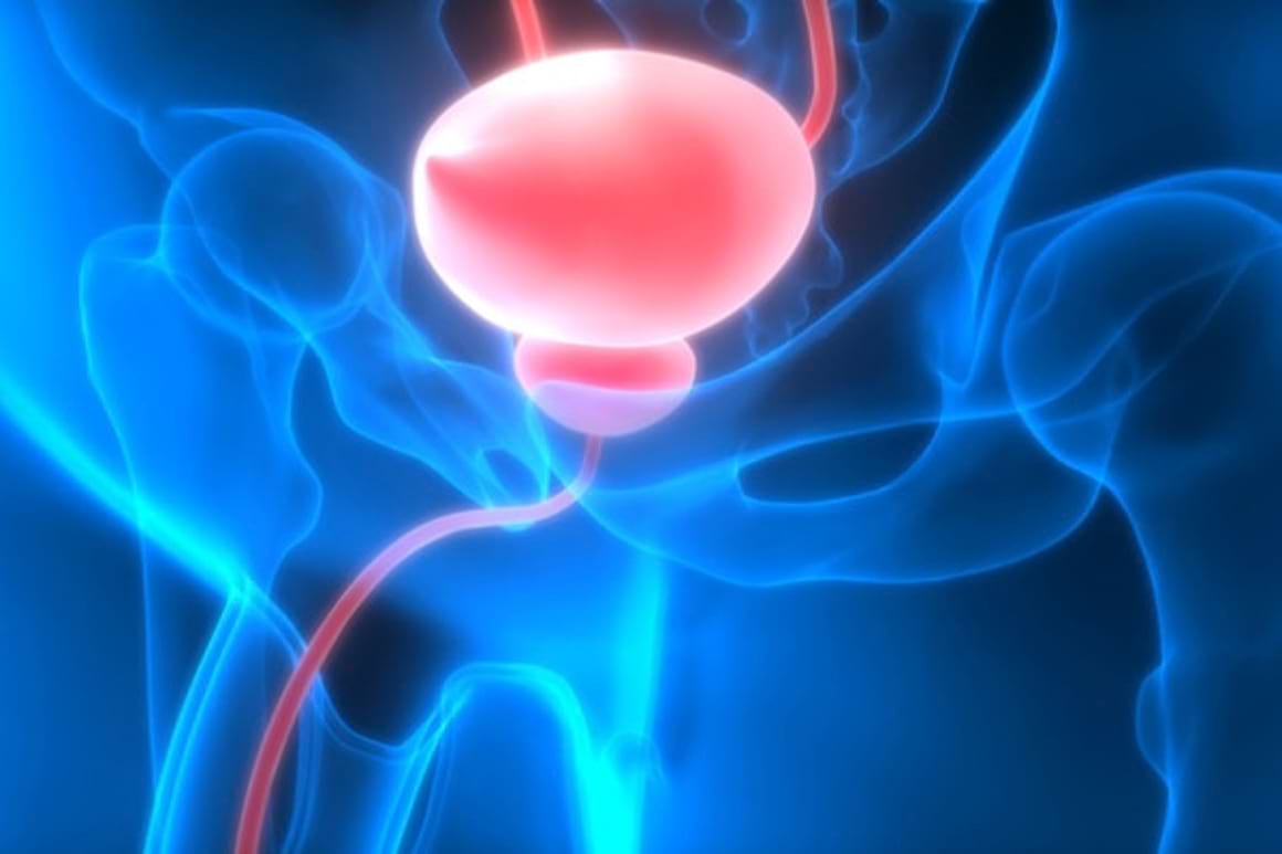 Managementul cancerului vezicii urinare local avansat, nerezecabil