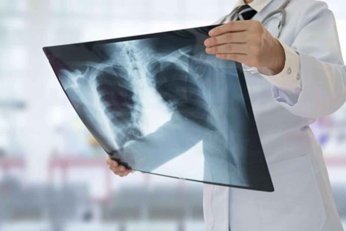 Pneumonia de la A la Z: semne, incubatie, remedii din plante
