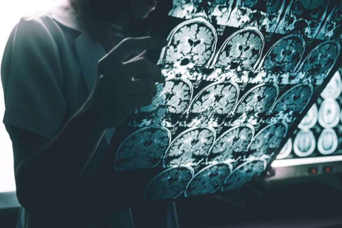 Scleroza laterala amiotrofica: cauze, simptome si tratament