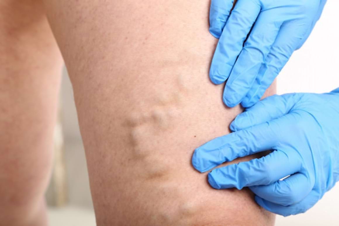 Simptomele insuficientei venoase cronice