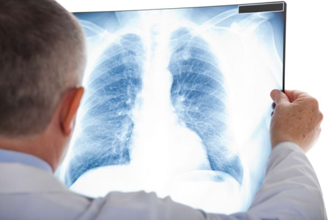 Sportul injumatateste riscul de complicatii dupa operatia de cancer pulmonar