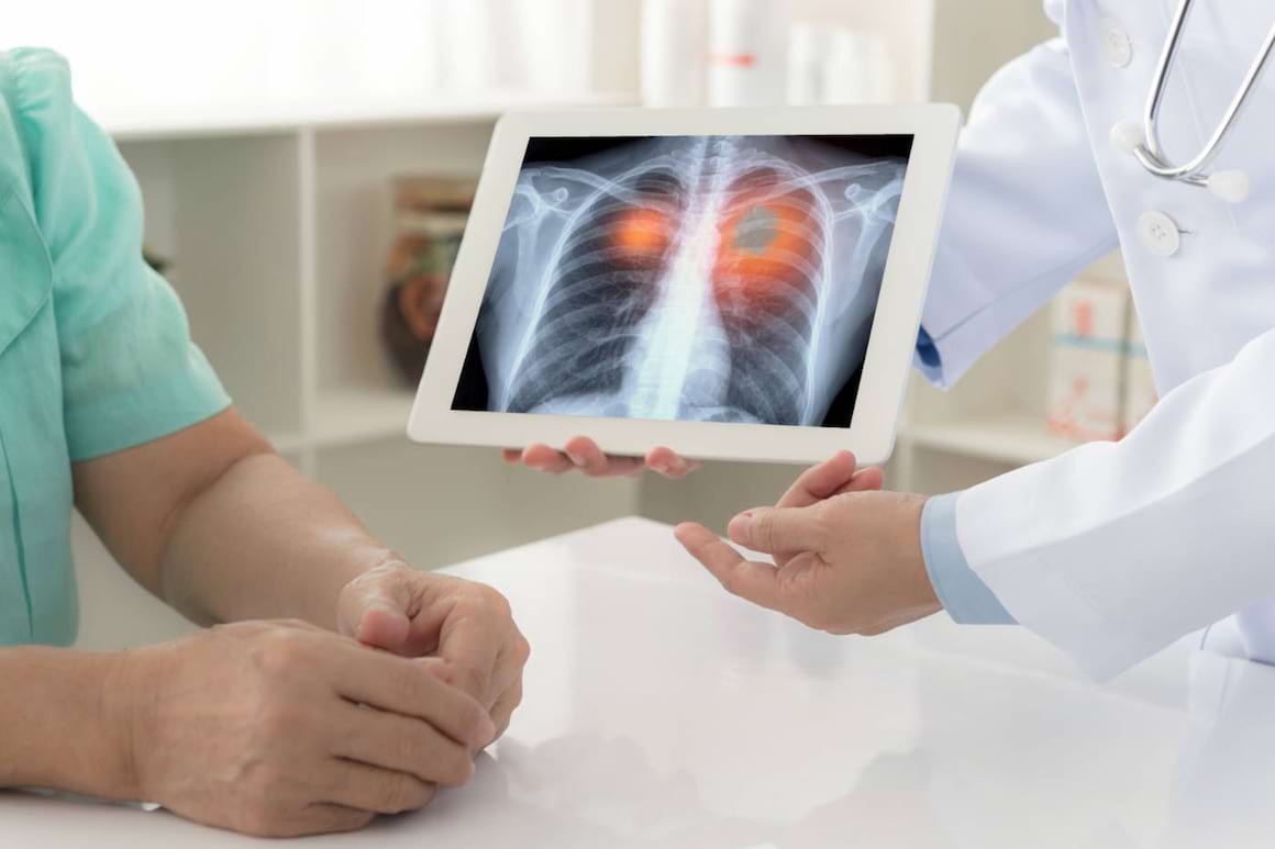 Hiperprogresia cancerului pulmonar fără celule mici în contextul imunoterapiei