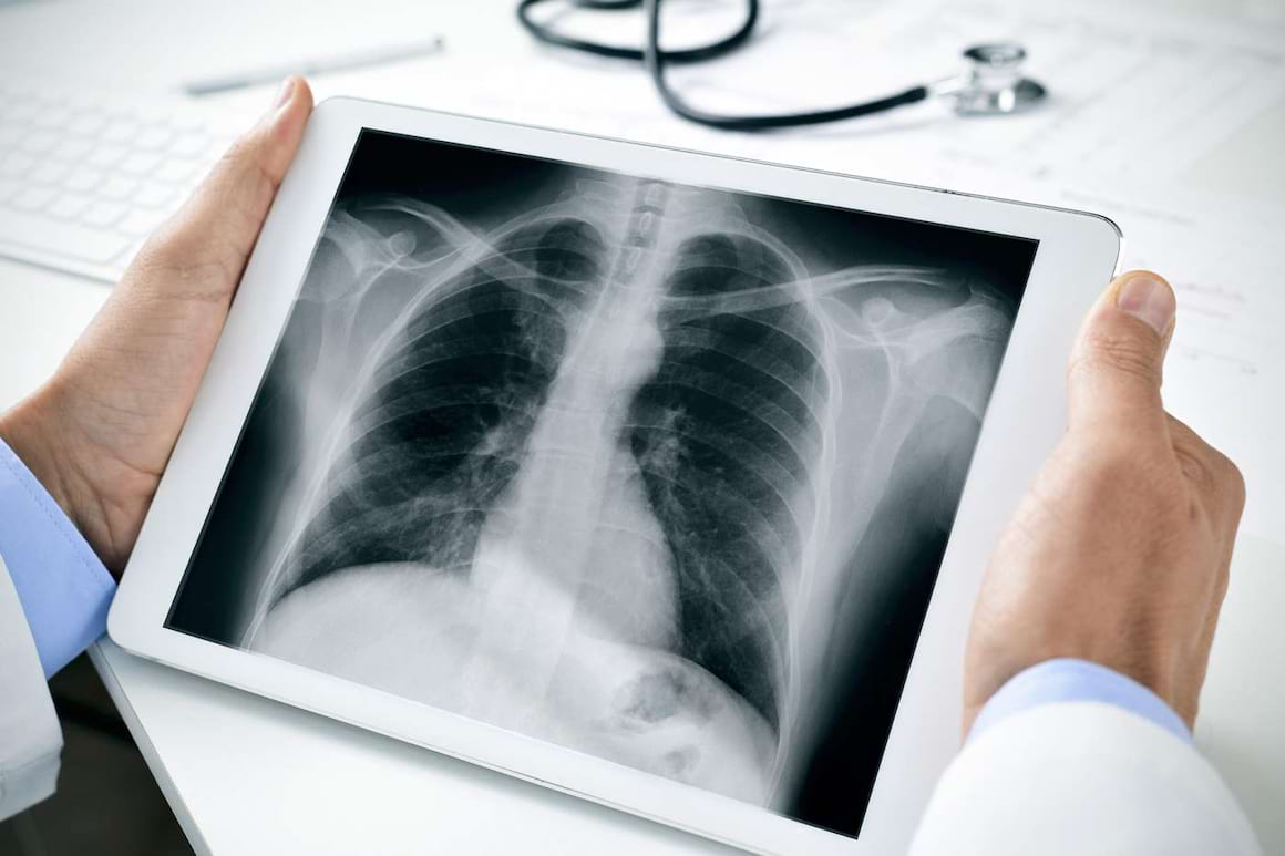 Leziunile pulmonare cauzate de țigările electronice seamănă cu arsurile chimice [studiu]
