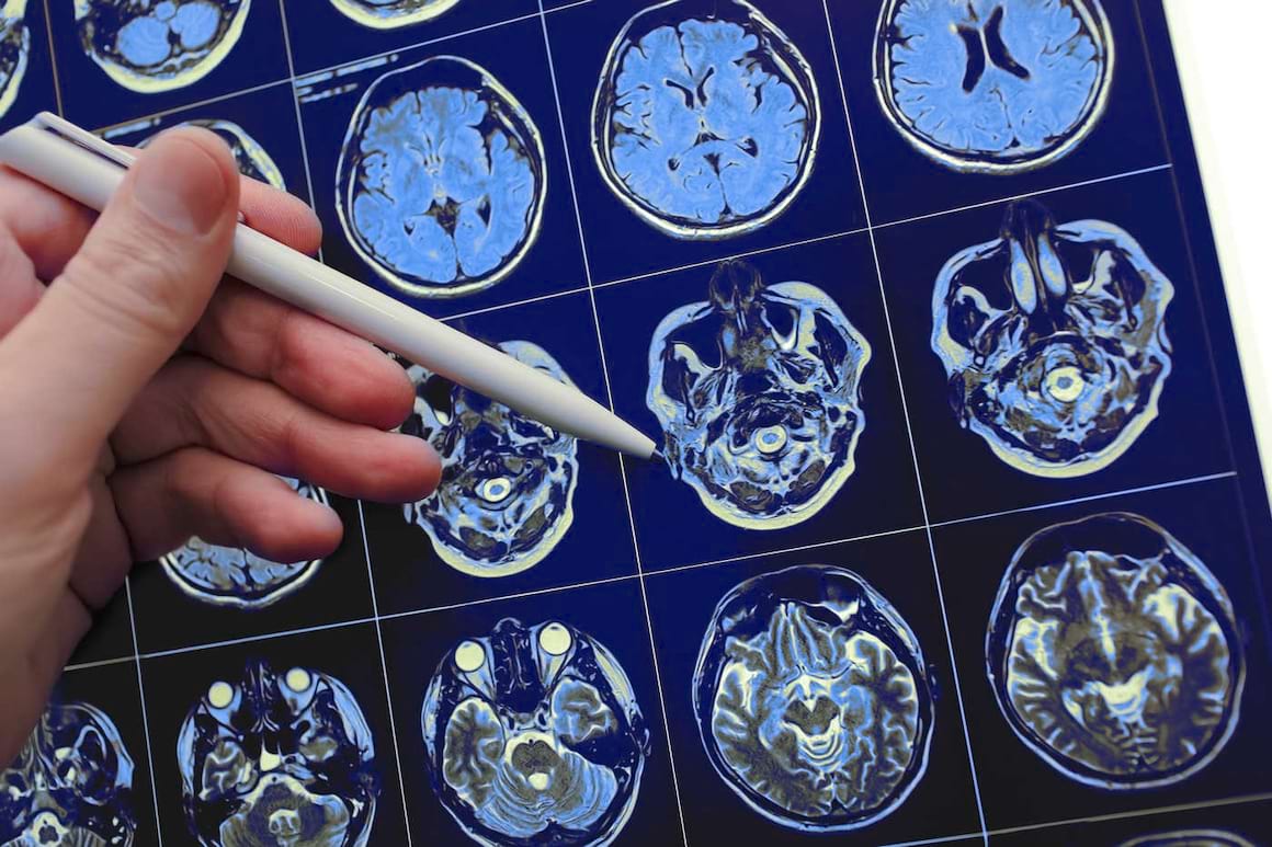 Opțiuni de tratament în cazul femeilor afectate de cancer mamar cu metastaze cerebrale