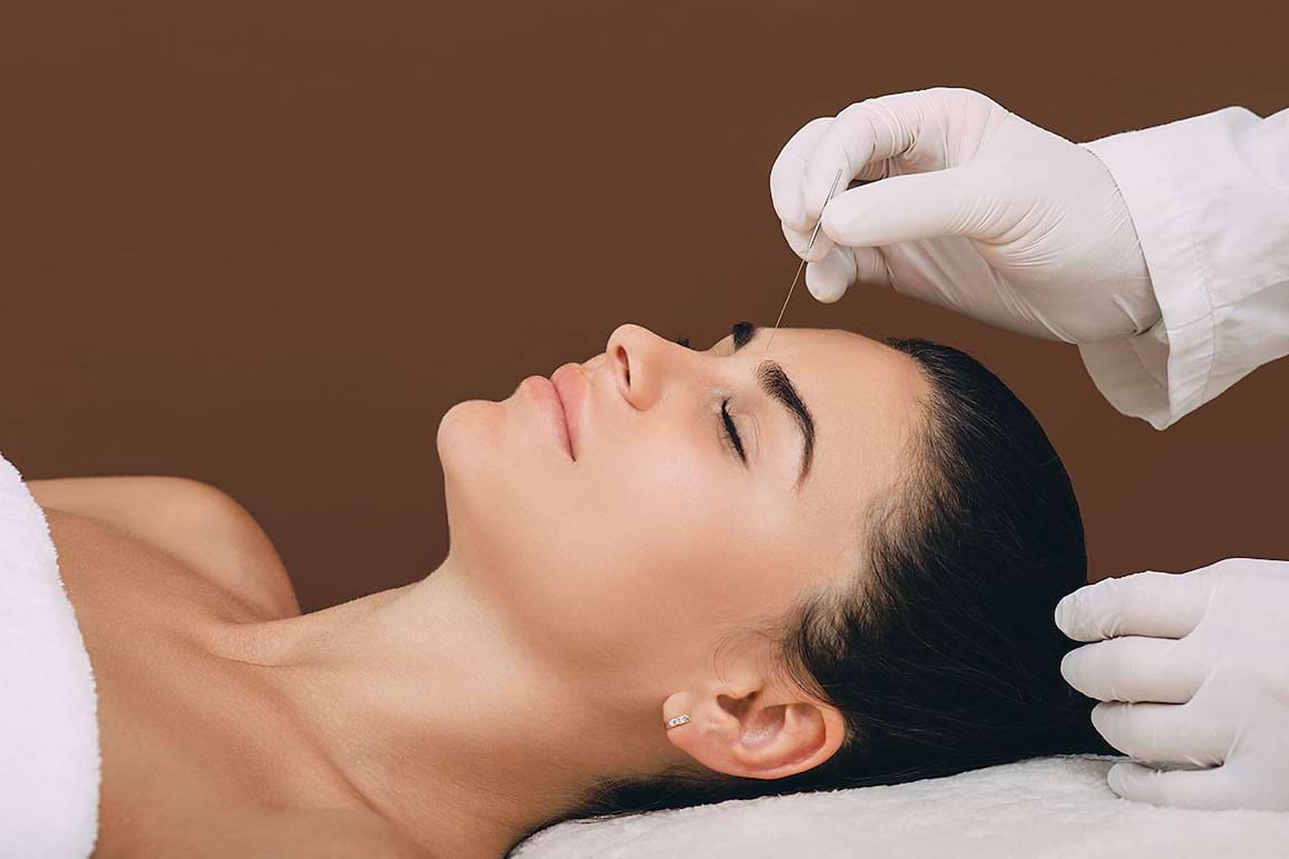Acupunctura reduce durerile de cap asociate cu migrena [studiu]