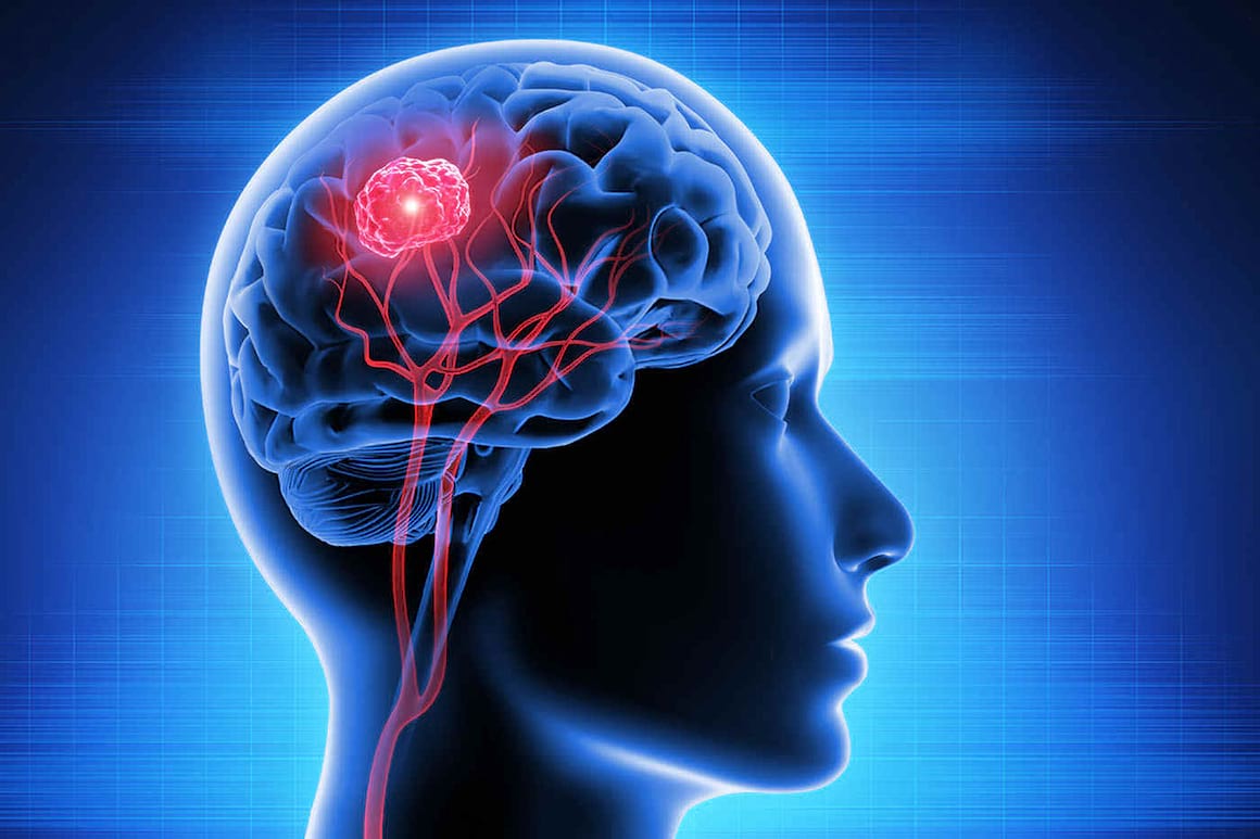 Prevenția apariției metastazelor cerebrale în cancerul mamar - cât de aproape suntem?