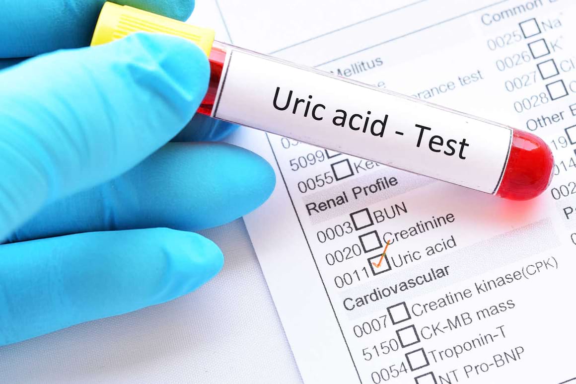 Acidul uric joacă un rol important în sindromul metabolic [studiu]