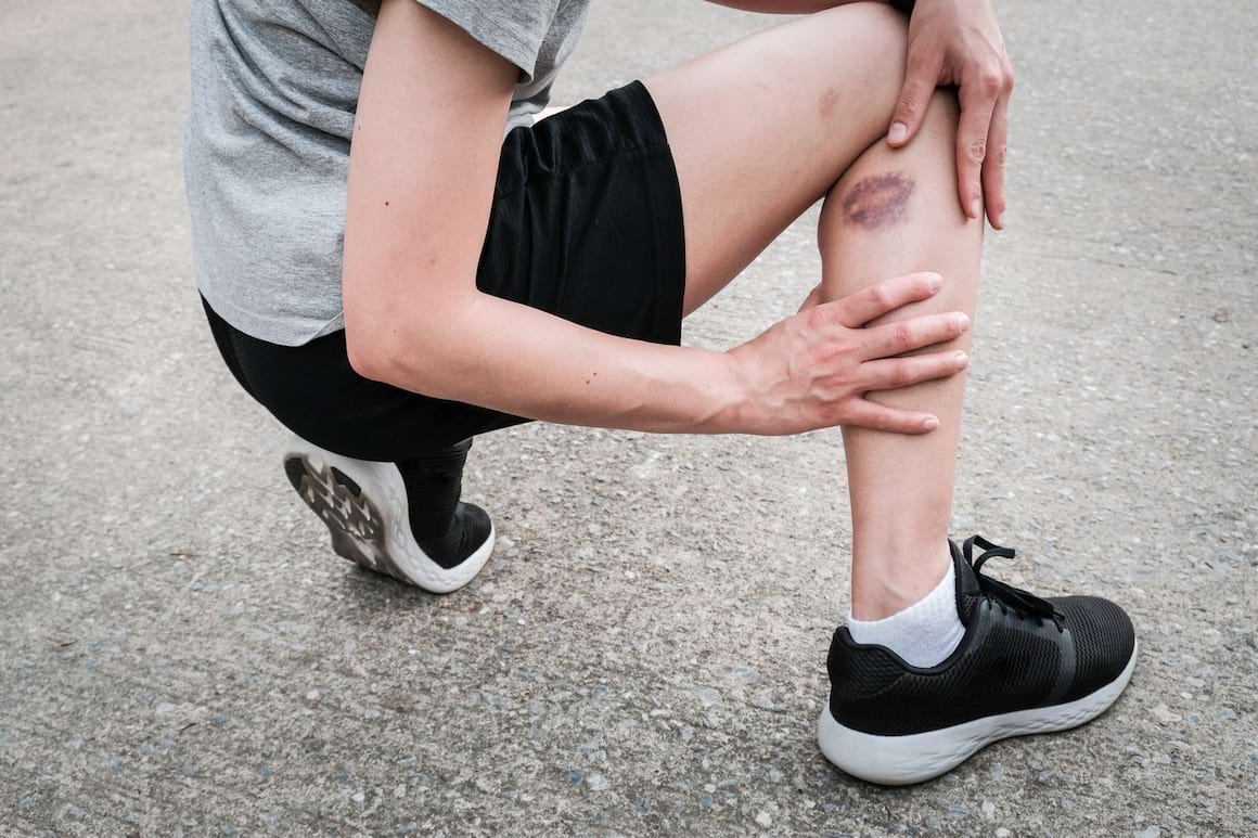 Lipsa de vitamina C și de vitamina K poate duce la apariția vânătăilor