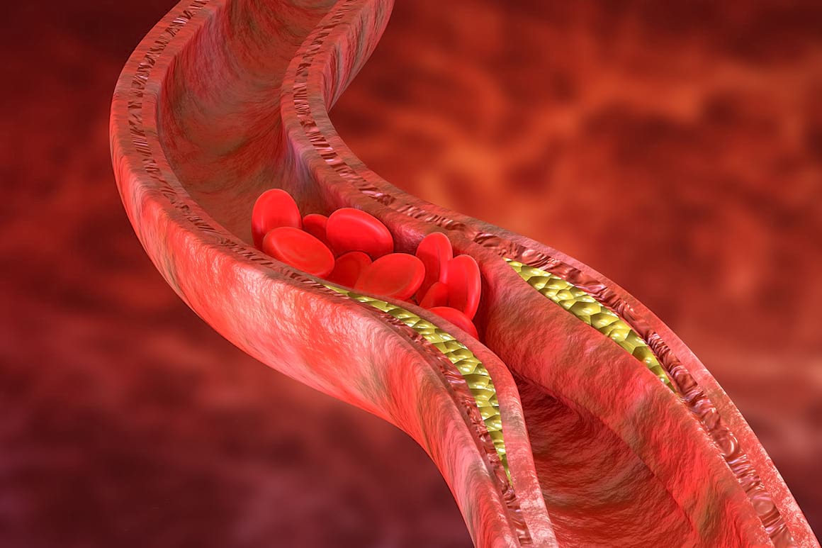 Ateroscleroza, prevenită cu ajutorul unor peptide? [studiu]