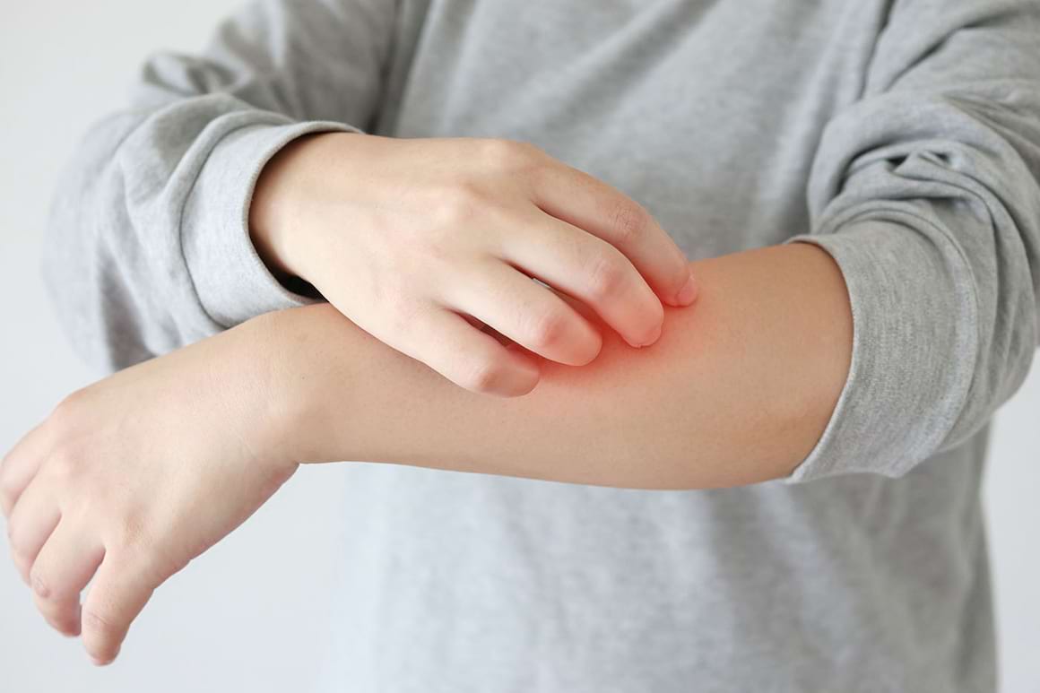 Mâncărimile asociate cu eczema, influențate de factorii de mediu [studiu]