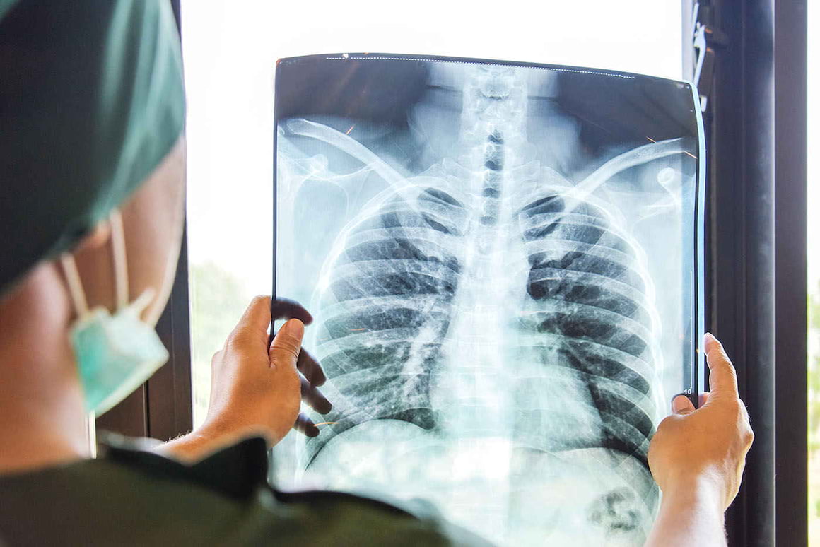 Un sistem imunitar slăbit poate duce la apariția cancerului pulmonar [studiu]