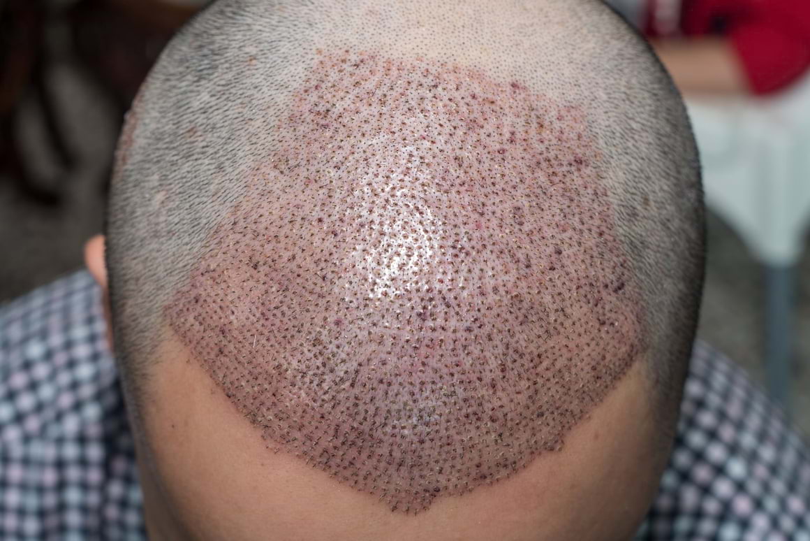 Cum identifici și tratezi o infecție apărută după implantul de păr?