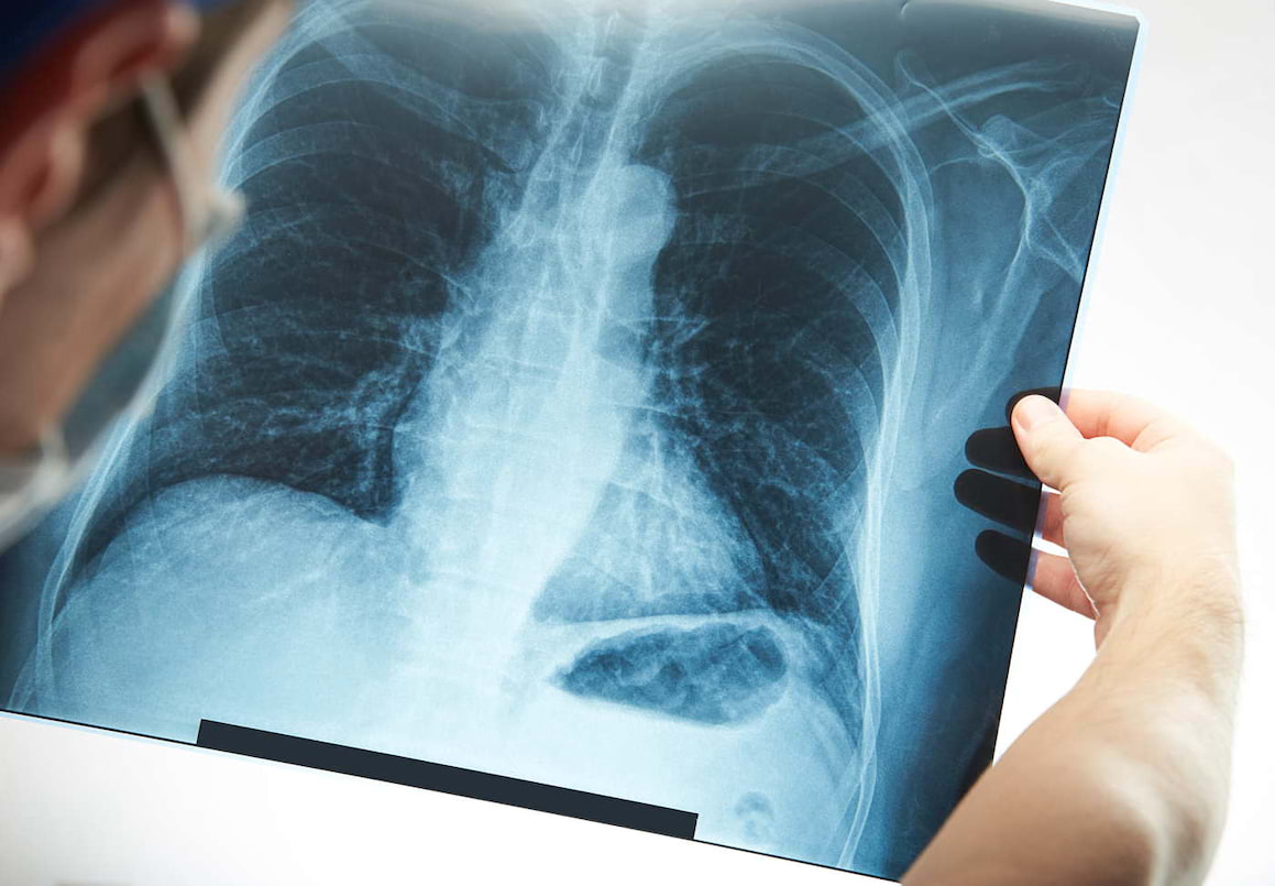 Monoimunoterapia sau terapia combinată în cancerul pulmonar fără celule mici