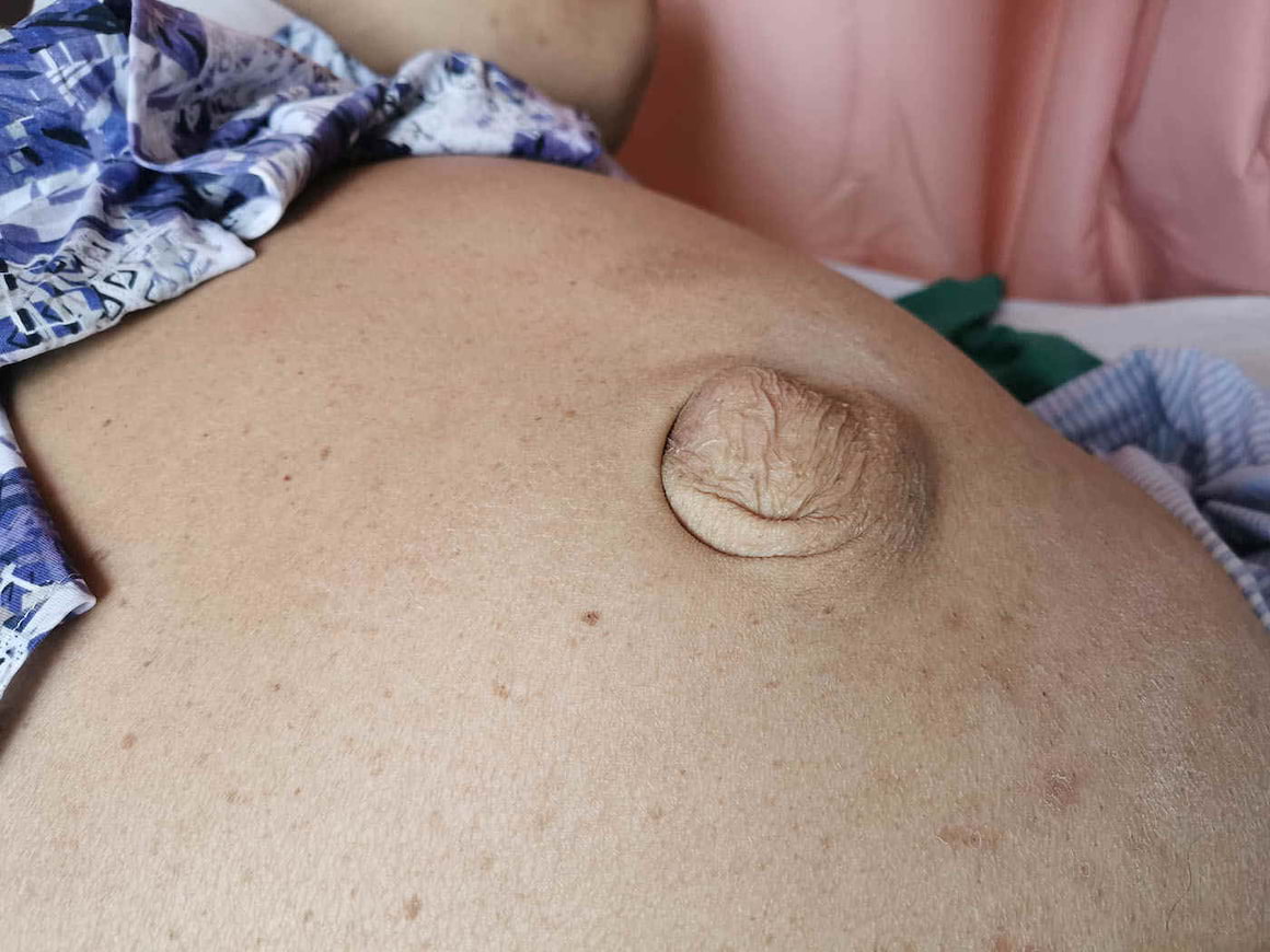 Hernia ombilicală la adulți - cauze, simptome și tratament