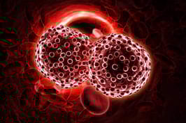 Cancerul Hepatic