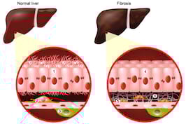 Stadiile Fibrozei In Hepatita C
