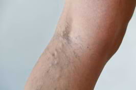 scleroterapie varicoza a venelor pe picioare de la apa potabila poate fi varicoza