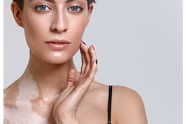 Cu Vitiligo La Plaja Cum Iti Protejezi Pielea