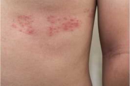 Totul Despre Zona Zoster Herpes Zoster Cauze Simptome Tratament