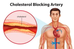 Ateroscleroza ar putea fi invinsa prin injectarea unor nanofibre [studiu]