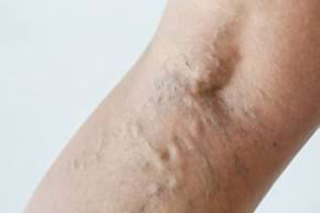 Clasificarea clinica a insuficientei venoase cronice