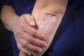 Dieta &icirc;n psoriazis: cum reduci inflamația din organism?