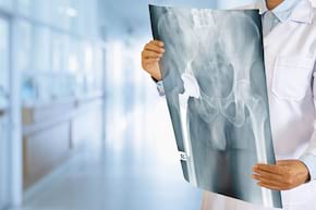 Fractura de șold: cum reduci riscul de recurență
