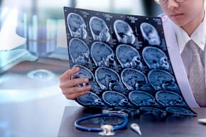 Leziunile cerebrale cauzate de AVC ar putea fi reparate cu celule stem?