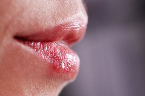 Herpesul și sexul oral: care sunt riscurile la femei? (studiu)