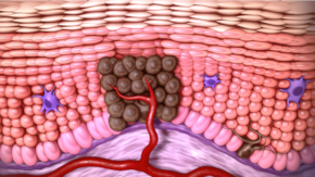 Totul despre Carcinomul Bazocelular și Carcinomul Scuamocelular