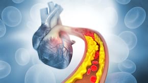Ateroscleroza: cauze, simptome, tratament