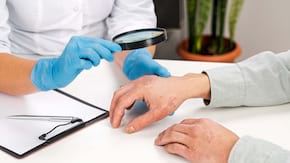 Psoriazis: cauze, simptome si tratament
