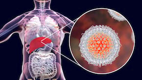 Hepatita C creste riscul dezvoltarii de cancer la ficat si alte tipuri de cancer