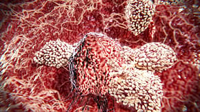 Imunoterapia in cancerele hepatobiliare, a doua cauza de deces prin cancer la nivel mondial