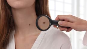 Cat de des ne autoexaminam alunitele si cat de des mergem la dermatolog?