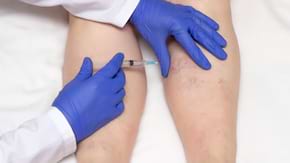Ce este microscleroterapia si cum te ajuta daca ai telangiectazii?