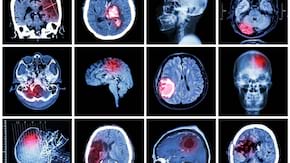 Diagnosticul imagistic la pacientii cu AVC