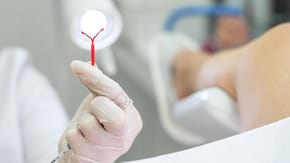 Steriletul: tipuri, eficacitate, avantaje si dezavantaje
